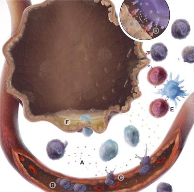 Lymphocytic Airway Inflammation in Lung Allografts